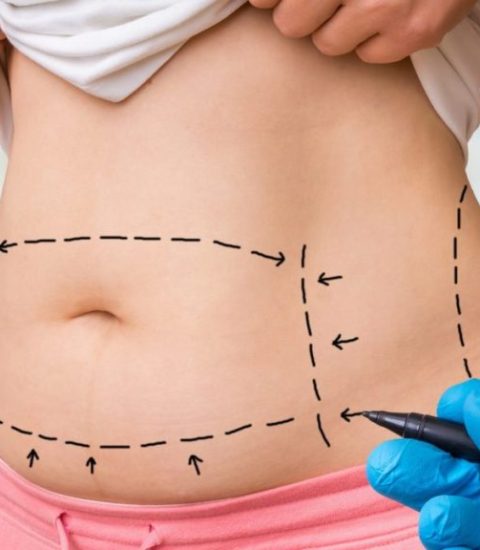 Plastic Surgery Doctor Draw Lines With Marker On Patient Belly A