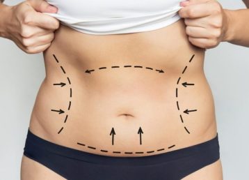 Close-up,Of,A,Woman's,Belly,With,Excess,Fat,With,Marking